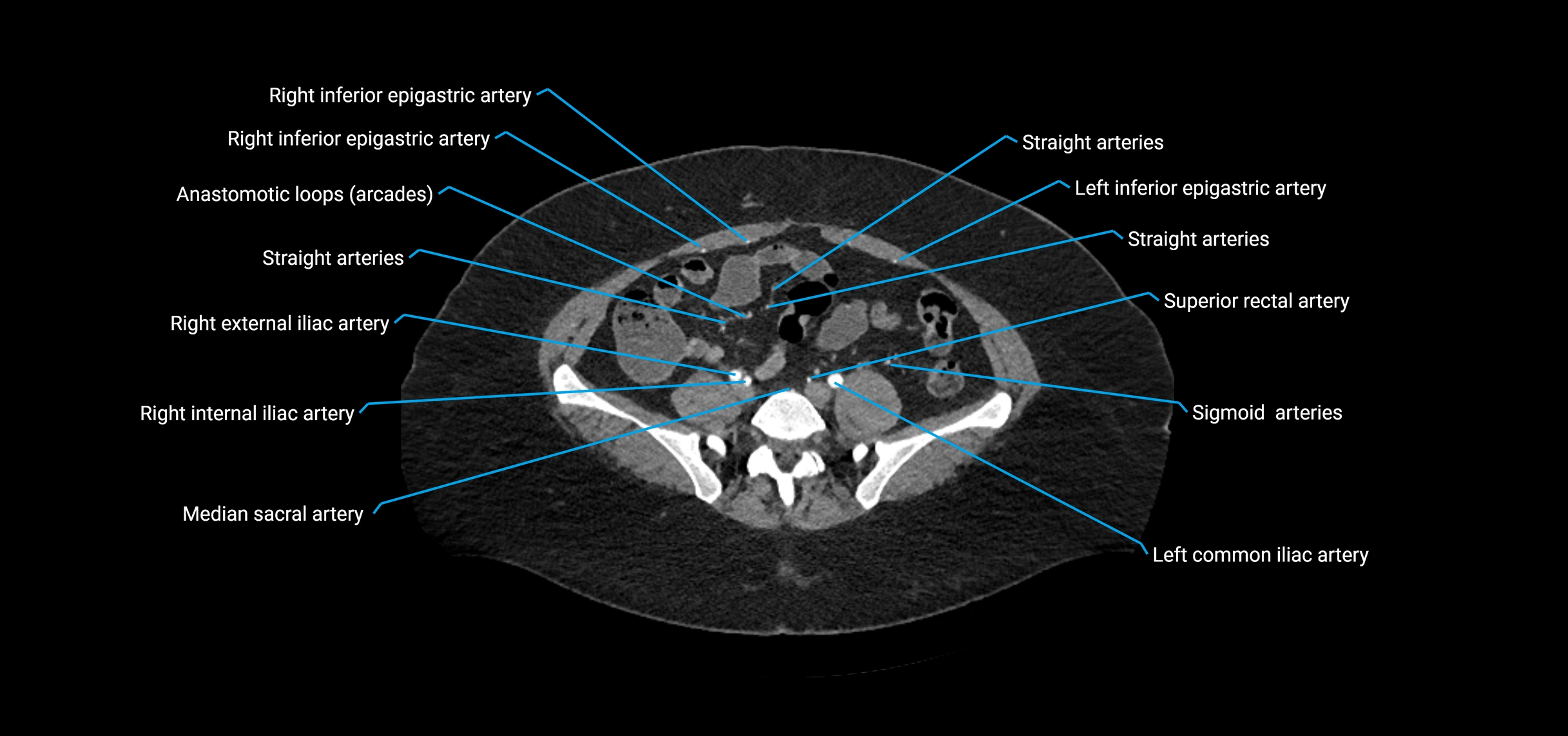 CTA abdomen axial cross sectional anatomy labelled image_169 (2).webp
